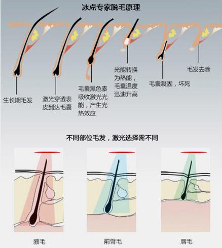 用脱毛剂会越长越多吗